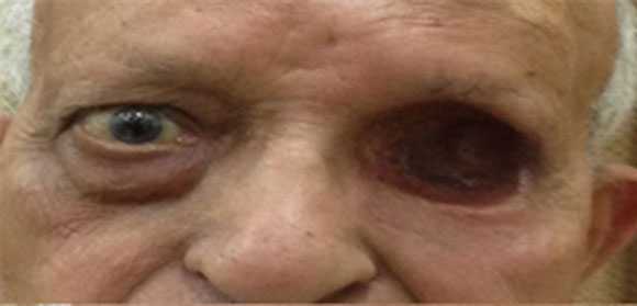 spectacle orbital prosthesis India